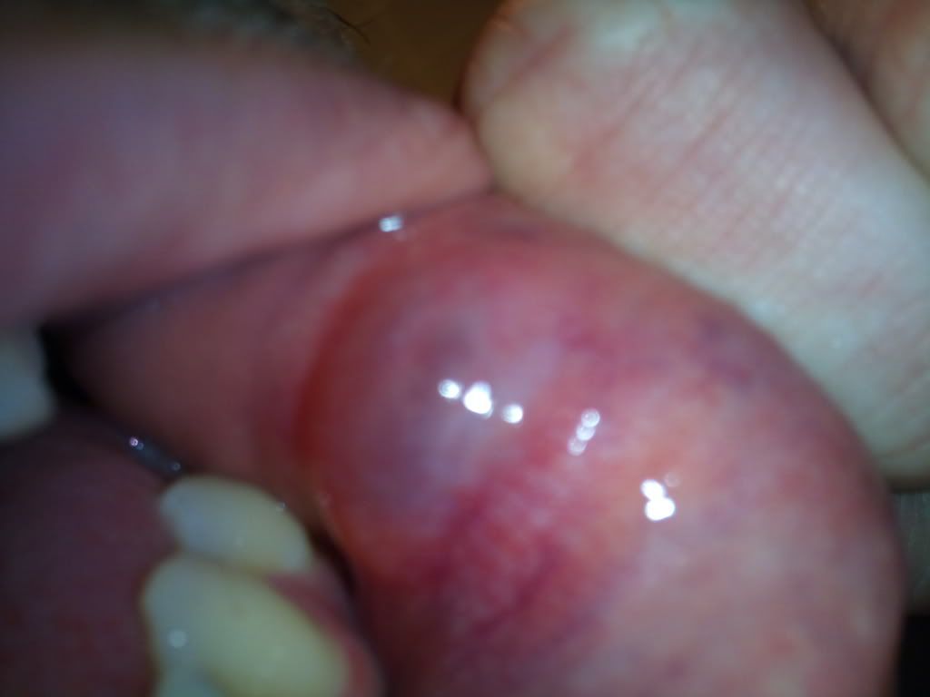 lip mucocele