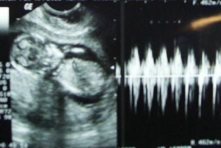 12w2d ultrasound (2)