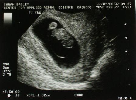 7w5d ultrasound(2)